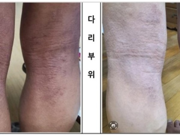 다리(오금) 부위 건조함 및 피부 컨디션 집중 관리 사례